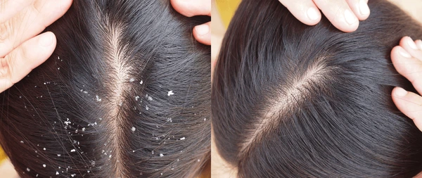 Flake Free Scalp Control Dandruff With Lemon Peel Powder Kerala